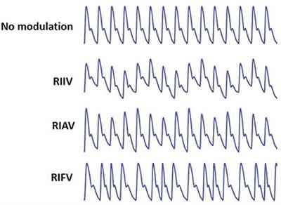 Extracting Instantaneous Respiratory Rate From Multiple Photoplethysmogram Respiratory-Induced Variations